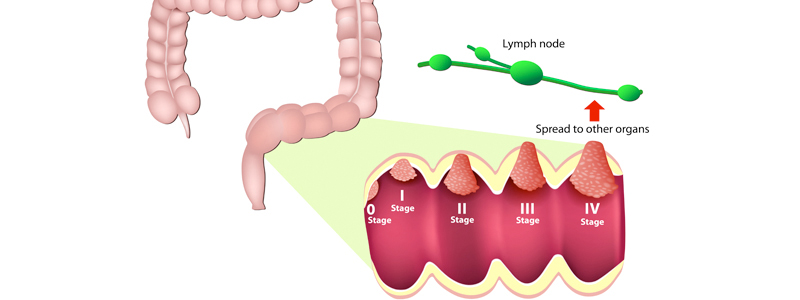 Colon and Rectal Image | Arizona Advanced Surgery