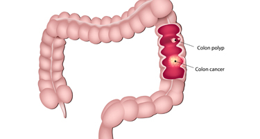 Colon and Rectal Image | Arizona Advanced Surgery