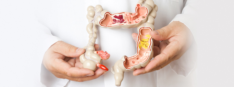 Colon Resection Image | Arizona Advanced Surgery