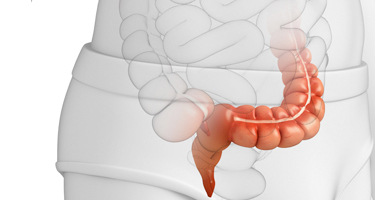 Colon Resection Image | Arizona Advanced Surgery