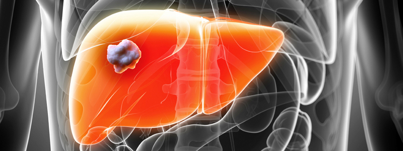 Liver Procedures Image | Arizona Advanced Surgery