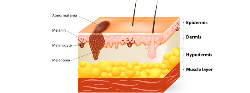 Melanoma & Soft Tissue Sarcoma Image | Arizona Advanced Surgery