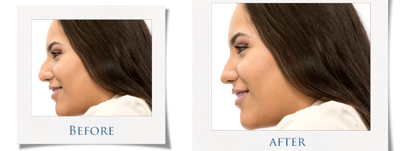 Rhinoplasty (Nose Surgery) Image | Arizona Advanced Surgery