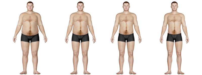 Bariatric Surgery Image