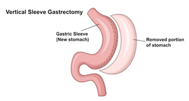 Arizona Advaned Surgery | Bariatric Surgery Image